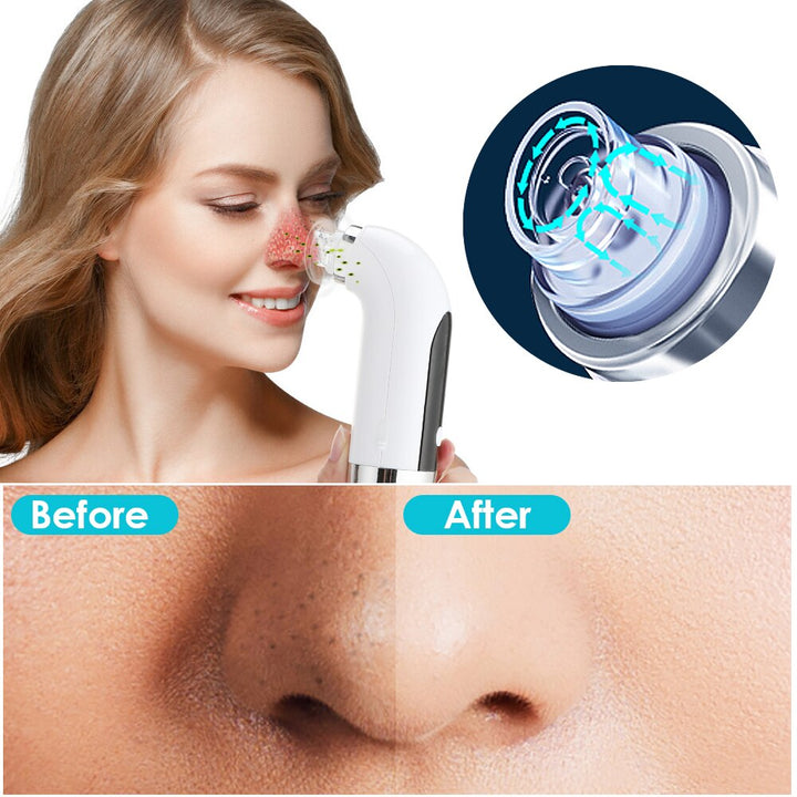 UZ Pore cleaner vacuum cleaner acne pimple remover - OZAXU